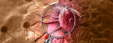 Nowotwory złośliwe po mitoksantronie w stwardnieniu rozsianym