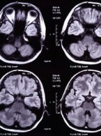 Udar mózgu – zaburzenia połykania we wczesnej fazie